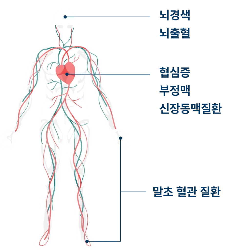 Medical illustration of vascular disease